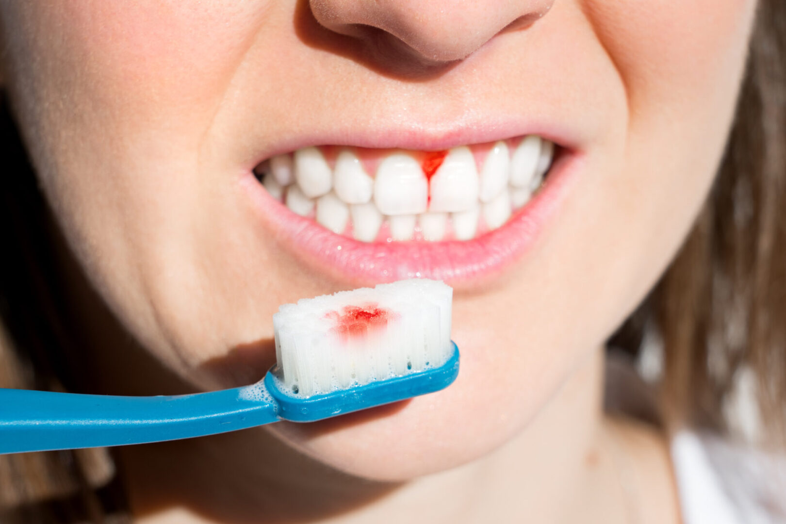 Woman with bleeding gums during teeth brushing. Hard toothbrush problem. Periodontal disease, avitaminosis, gingivitis, scurvy. High quality photo